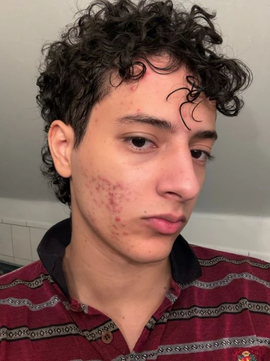 AI Blemish Remover style Blemish