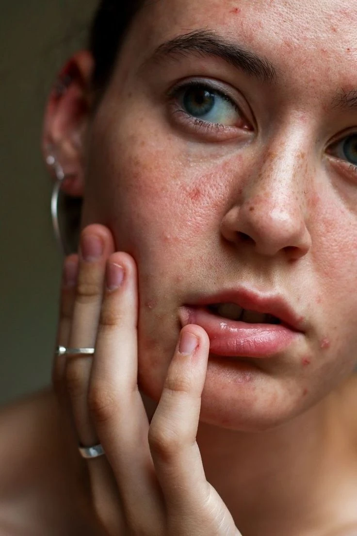 AI Blemish Remover style Acne