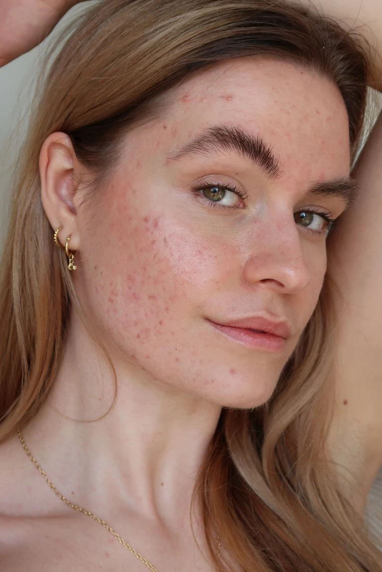 AI Blemish Remover style Dark Spots